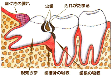 em炸̃C[WP